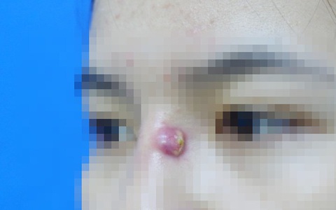 Cô gái trẻ bị mụn trứng cá mủ dai dẳng, nguyên nhân có liên quan đến nâng mũi bằng đặt sụn silicon