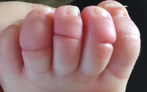 Thấy ngón chân của con đột nhiên bị sưng phồng, bà mẹ đưa con đi khám và sững sờ khi nghe bác sĩ nói nguyên nhân