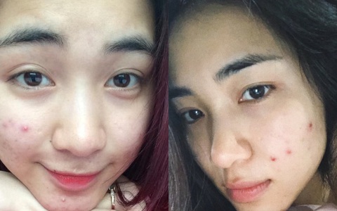Không uống được nước diếp cá để trị mụn như Hòa Minzy, bạn hãy dùng 5 món skincare mang thành phần lợi hại này