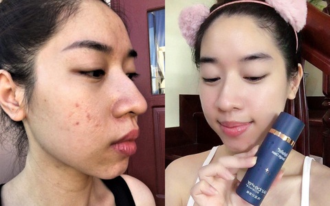 Từ da mụn sưng đỏ, lỗ chân lông to, cô bạn này đã làm gì để lấy lại làn da đẹp phát hờn, căng mướt không tì vết?