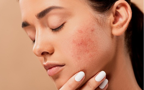 Chị em chăm vận động ướt đẫm mồ hôi cẩn trọng gặp phải loại mụn đáng sợ này!