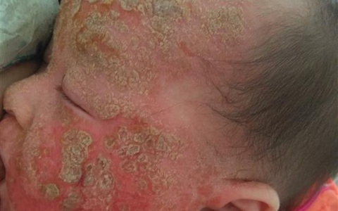 Mẹ bỉm đã từng quyết định không đẻ thêm vì sợ con sẽ lại bị viêm da cơ địa giống bé đầu: ''Khổ mẹ khổ con khóc hết nước mắt''