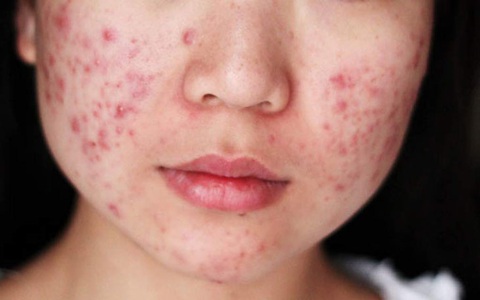 Người sắp bị ung thư gan thì trên mặt sẽ xuất hiện 3 biểu hiện bất thường, hãy đảm bảo "2 uống - 2 không ăn", lá gan sẽ cảm ơn bạn!