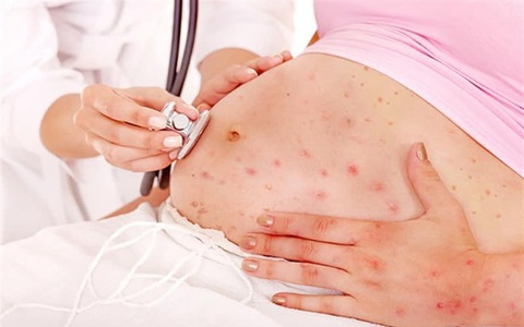 Những biến chứng nguy hiểm khó lường với con nếu mẹ bị thủy đậu khi mang thai