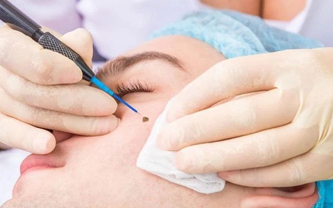 Cô gái 20 tuổi bị vi khuẩn "ăn" mất nửa van tim chỉ vì đi tẩy nốt ruồi