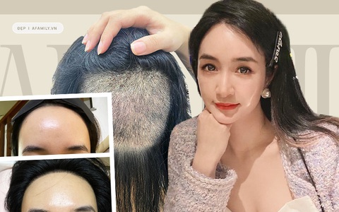 Chi 90 triệu để cấy tóc "trị" trán dô: Cô nàng này thú nhận từng bất an cực độ vì tóc rụng lả tả, sau nửa năm mới dám thở phào nhẹ nhõm