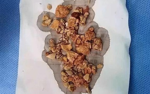 Con 5 tháng đã bị sỏi thận phải phẫu thuật gấp, bác sĩ mắng té tát vì sai lầm của gia đình