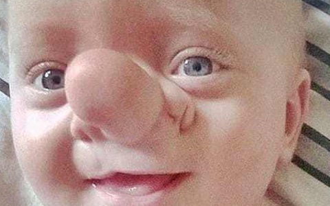 "Cậu bé Pinocchio đời thực” sinh ra với chiếc mũi to dị dạng khiến bố mẹ cũng sốc, gây bất ngờ với diện mạo sau ít năm