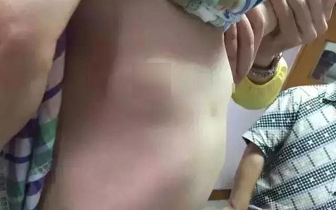 Bé gái 6 tuổi có cục u ở ngực do dậy thì sớm, nguyên nhân xuất phát từ món trứng rất quen thuộc