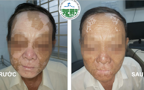 Đột nhiên mất thính lực và da nổi đốm, coi chừng mắc căn bệnh làm tóc và lông mi trắng như "dị nhân"