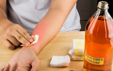Thực hư rượu giấm táo giúp trị cháy nắng và lời khuyên đến từ các chuyên gia