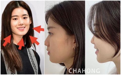 3 kiểu béo mặt mà chị em rất hay gặp phải: Cách khắc phục không hề khó, có cách còn cho kết quả ngay tức khắc