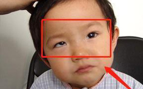 Bé trai 5 tuổi mắt thâm đen, con ngươi 1 bên mắt "biến mất", bị lác nghiêm trọng bởi thói quen "dễ dãi" của nhiều bố mẹ trẻ