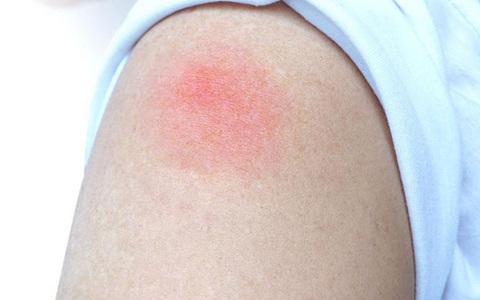 Phản ứng “cánh tay COVID-19” sau tiêm vaccine có đáng ngại?