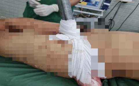 Tai nạn kinh hoàng: Nam thanh niên bị thanh sắt xuyên từ bẹn đùi ra sau mông, treo người trên thành cầu