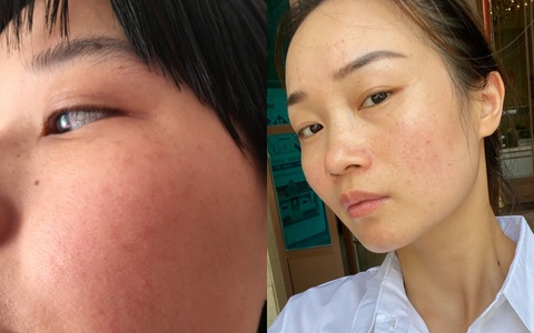 Làn da xuất hiện 5 dấu hiệu này thì chứng tỏ bạn đang bị kích ứng với mỹ phẩm đang dùng 