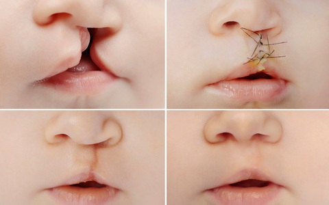 Phẫu thuật sứt môi, hở hàm ếch: Từ lưu ý đến giá cả, nơi nên thực hiện được chuyên gia chia sẻ tường tận