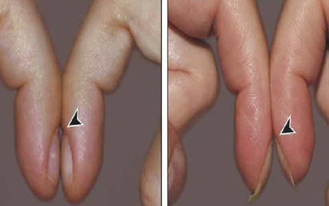 Một hành động tưởng vô nghĩa nhưng lại giúp bạn nhận biết nguy cơ mắc ung thư phổi từ sớm, không tin làm thử ngay!