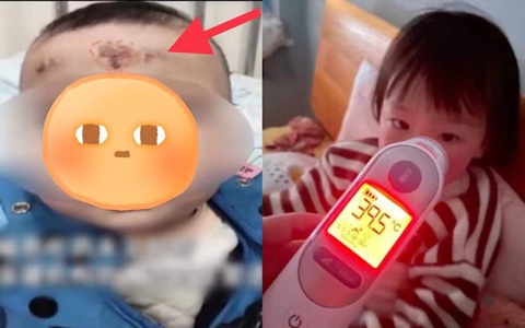 Bé gái 10 tháng tuổi xuất hiện dấu hiệu lạ trên trán, mẹ hốt hoảng đưa con đến bệnh viện rồi ngã ngửa vì cách chữa bệnh "theo kiểu bà ngoại"