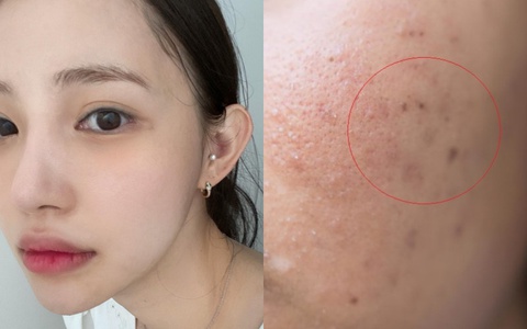Sẹo rỗ sau mụn: 2 cách đơn giản trị sẹo, tăng sinh collagen được bác sĩ da liễu khuyên dùng