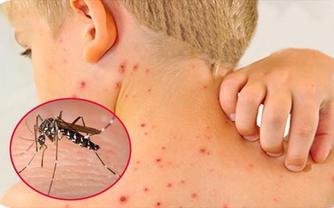 Dịch sốt xuất huyết lớn có nguy cơ xảy ra vào cuối năm 2022: Cảnh báo những đối tượng mắc sốt xuất huyết dễ bị trở nặng