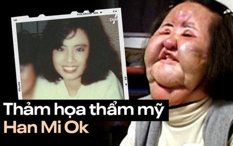 "Thảm họa thẩm mỹ" xứ Hàn: Nữ ca sĩ 17 lần phẫu thuật cứu vãn nhan sắc vì tự tiêm dầu ăn và cái chết bí ẩn tuổi 57
