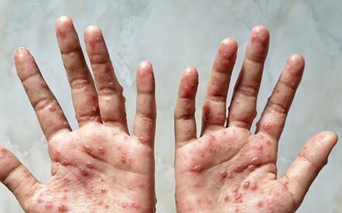 6 khuyến cáo phòng chống bệnh đậu mùa khỉ