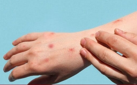 Ca đậu mùa khỉ đầu tiên ở Việt Nam sức khỏe ổn định, ăn uống tốt, lên cân