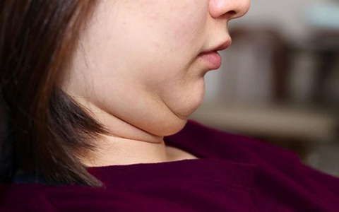 Đoán bệnh qua vị trí mỡ thừa ở từng vùng trên cơ thể của bạn