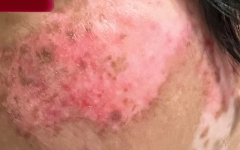 Dùng đơn thuốc cũ chữa lupus ban đỏ, nữ bệnh nhân trẻ phải lọc máu cấp cứu