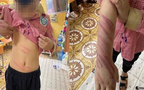Xác minh vụ bé trai 8 tuổi bị người tình của mẹ bạo hành