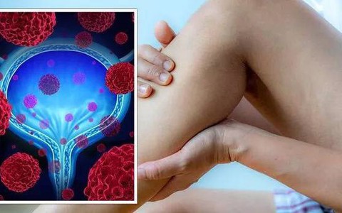 Gặp những biểu hiện này khi đi tiểu, coi chừng bệnh ung thư bàng quang đang "tìm đến" bạn