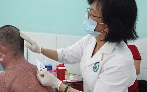 Nhập viện vì dùng thuốc chữa vảy nến trên mạng