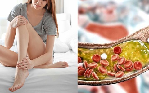 Dấu hiệu đầu tiên cảnh báo tình trạng cholesterol cao có thể làm tắc nghẽn động mạch của bạn