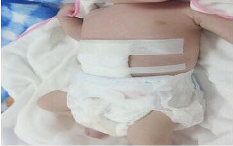 Cứu sống bé sơ sinh chào đời có ruột nằm ngoài ổ bụng