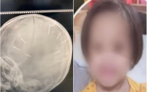 Thông tin mới nhất về tình trạng của bé gái 3 tuổi ở Hà Nội bị nhân tình của mẹ đóng đinh vào đầu