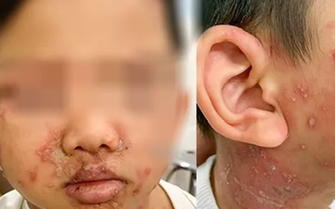 Cảnh báo viêm da tiếp xúc do kiến ba khoang