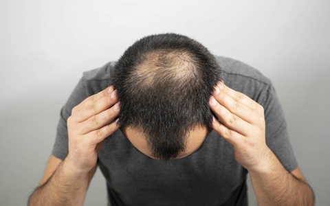 Finasteride 1mg trị rụng tóc ở nam giới