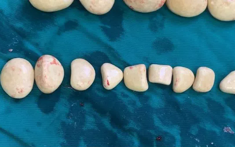 Phẫu thuật lấy hàng chục viên sỏi trong bàng quang bệnh nhân