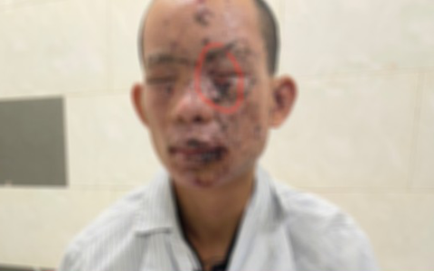 Nam thanh niên bị cháy sém toàn thân, mất thị lực do dùng điện thoại khi đang sạc