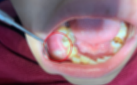 Bé 12 tuổi phải nhập viện vì biến chứng nang xương hàm