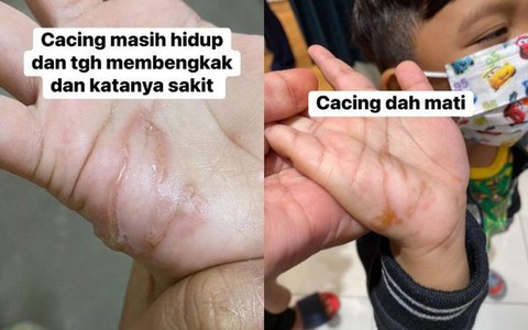 Sau khi nghịch cát, cậu bé cảm thấy ngứa ran lòng bàn tay, còn nói “có con gì đó chuyển động trong tay con mẹ ơi”