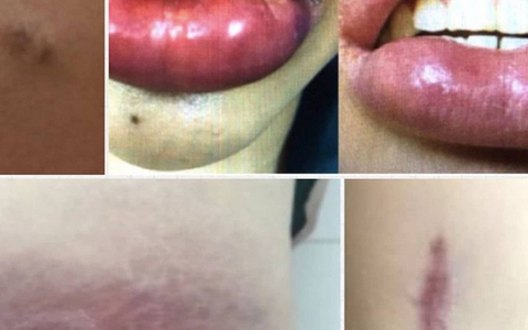 Tiêm filler "đội lốt" collagen, nhiều người gặp biến chứng