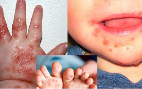 Hà Nội: Số ca mắc tay chân miệng tăng gấp 4 lần, không quên 3 dấu hiệu chuyển nặng