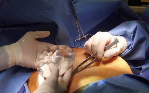 Nữ Việt kiều ôm ngực khổng lồ biến dạng như muốn "nổ" về nước cầu cứu bác sĩ