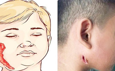 BS Trương Hữu Khanh nói về căn bệnh bị gọi tên 'vi khuẩn ăn thịt người'