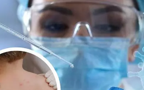 Biến chứng nguy hiểm của bệnh đậu mùa khỉ, không phải ai cũng biết