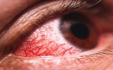 Châu Âu ghi nhận virus gây xuất huyết ở mắt, tỷ lệ tử vong đến 30%