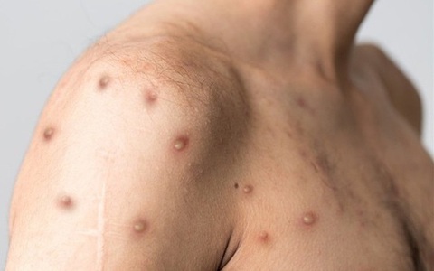 WHO kêu gọi ngăn đậu mùa khỉ trở thành đại dịch thứ hai sau COVID-19