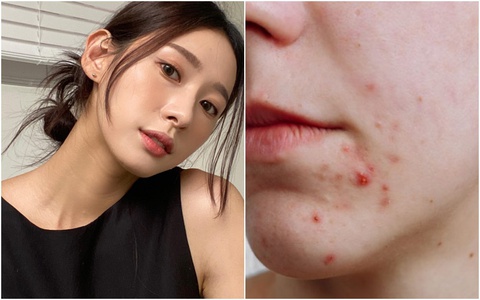 Ăn gì để hết mụn?